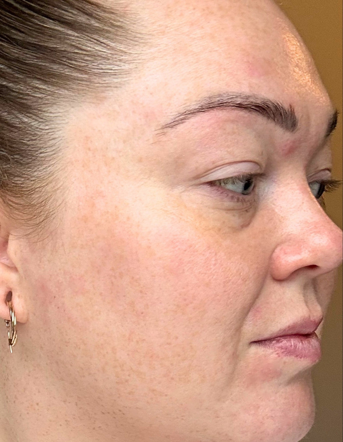 Stacey after 4 weeks of LumaLux Face