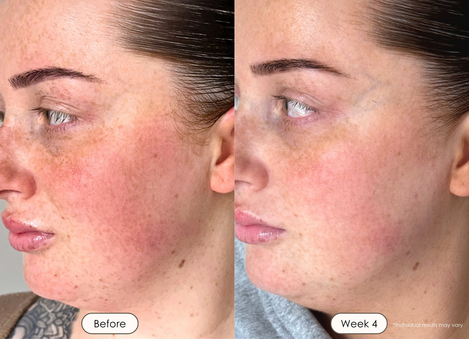 Before and after photos showing skin redness reduction after red light therapy.