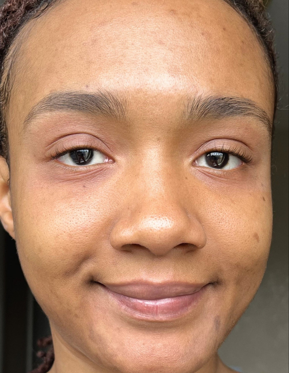 Deja after 4 weeks of LumaLux Face