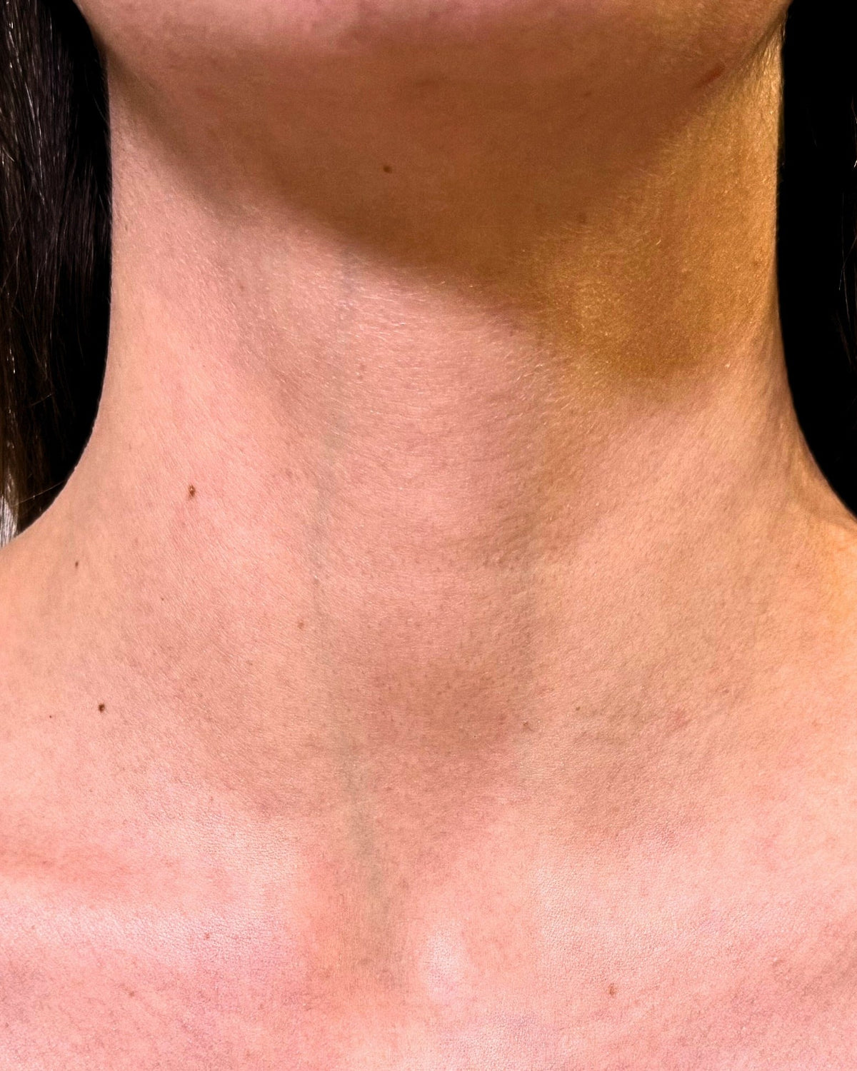 Tetiana's neck before using LumaLux Face+